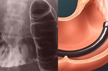 Irrigoscopie ou coloscopie intestinale: une comparaison et quoi de mieux