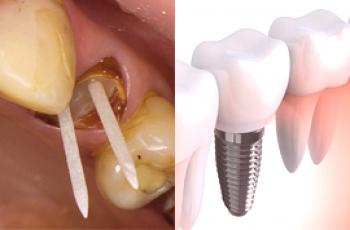 Quelle est la différence entre une broche et un implant et lequel est le meilleur?