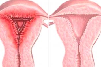 Endometritis y endometriosis: ¿qué es común y cuál es la diferencia?