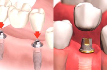 ¿Qué es mejor elegir un puente dental o implante?