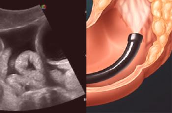 Ultrazvukové střevo nebo kolonoskopie - který postup je lepší?