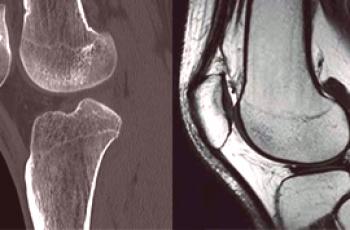 Jaký postup je lepší než CT nebo MRI kolena?