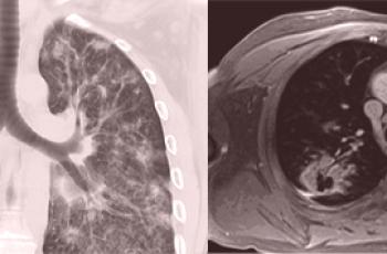 TDM et IRM des poumons: les différences et quoi de mieux