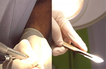 Quelle est la meilleure façon de circoncire avec un laser ou un scalpel?