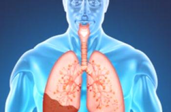 Kako se pneumonija razlikuje od upale pluća?