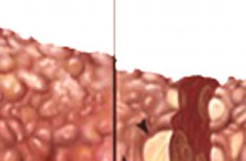 Ce qui distingue le cancer du foie de la cirrhose