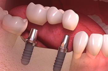 ¿Cuál es la diferencia entre la implantación y la prótesis?