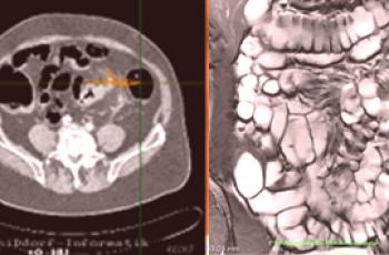 ¿Cuál es la mejor tomografía computarizada o resonancia magnética del intestino?