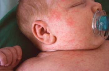 Co se liší od alergií: srovnání a rozdíly