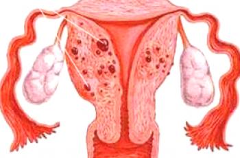 Koja je razlika između adenomioze i endometrioze?